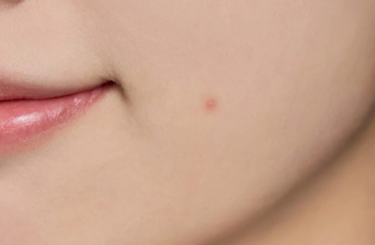 Skin1004 Tea Trica Spot Cover Patch - Imagen 7