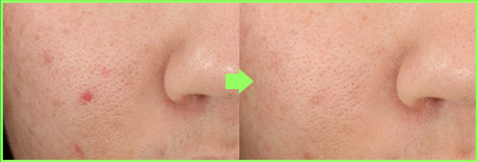 gel tratamiento acné tea tree - reducción sebo piel grasa