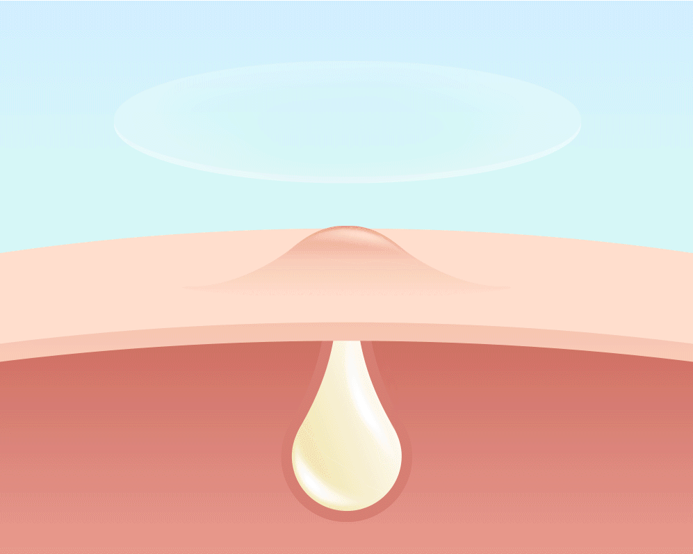 Parches hydrocolloid - Material absorción superior 700%